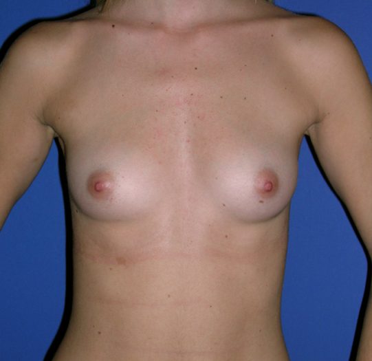 casos de éxito en operaciones de mama.