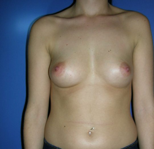 casos de éxito en operaciones de mama.